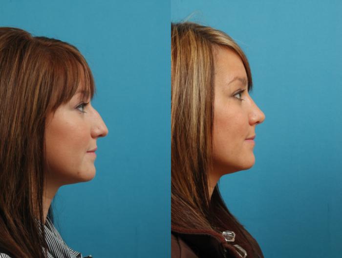 Before & After Rhinoplasty Case 6 Right Side View in West Des Moines & Ames, IA