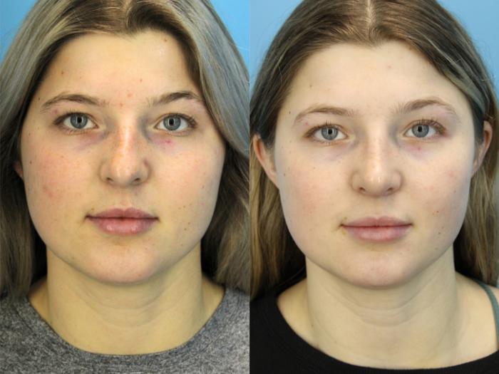 Before & After Rhinoplasty Case 605 Front View in West Des Moines & Ames, IA