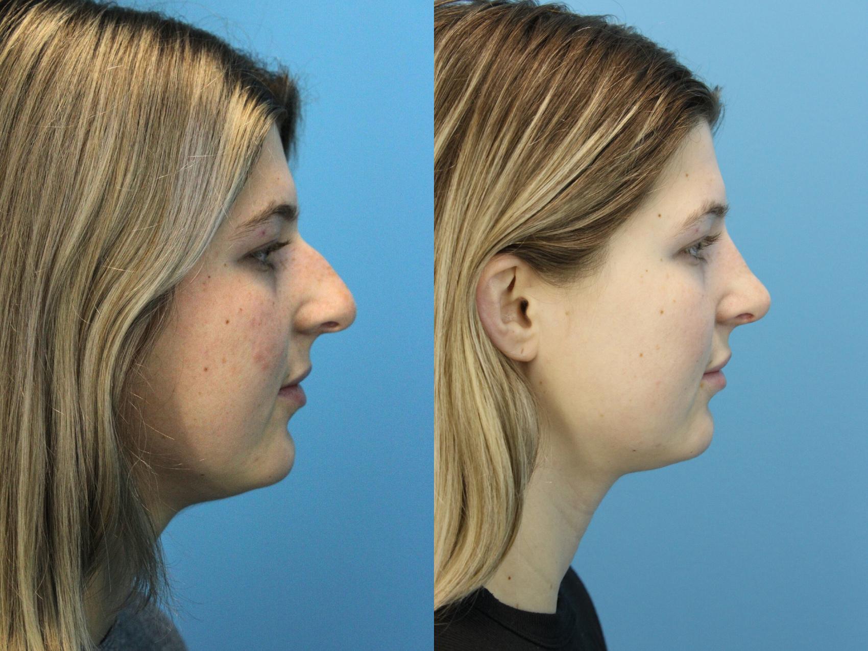 Before & After Rhinoplasty Case 605 Left Side View in West Des Moines & Ames, IA