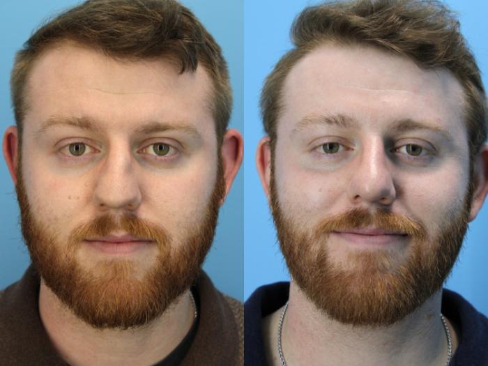 Before & After Rhinoplasty Case 629 Front View in West Des Moines & Ames, IA