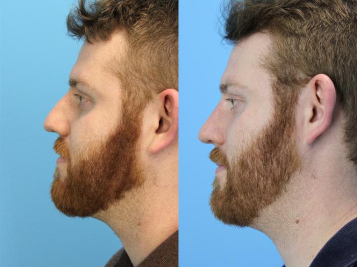 Before & After Rhinoplasty Case 629 Left Side View in West Des Moines & Ames, IA
