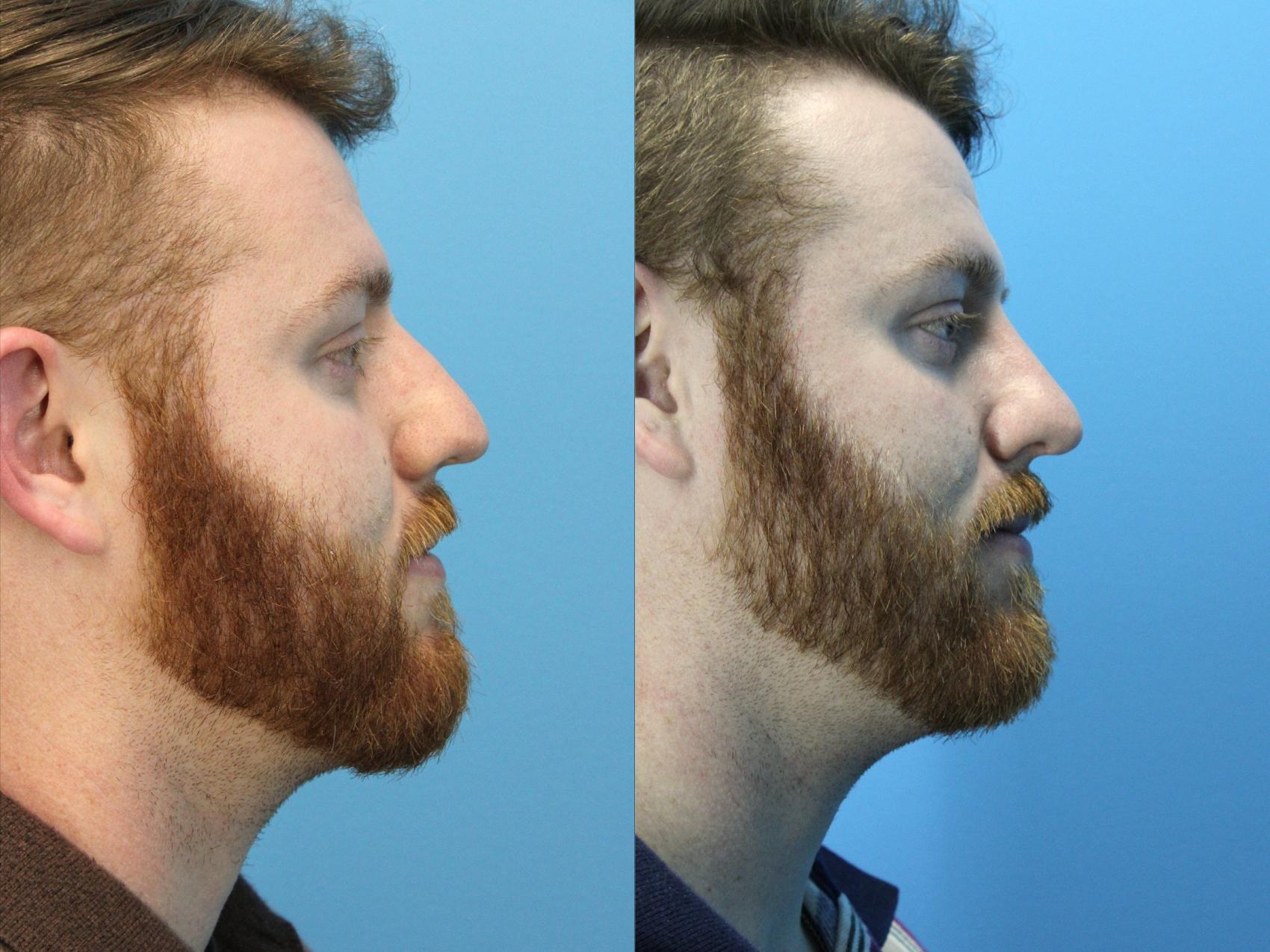 Before & After Rhinoplasty Case 629 Right Side View in West Des Moines & Ames, IA