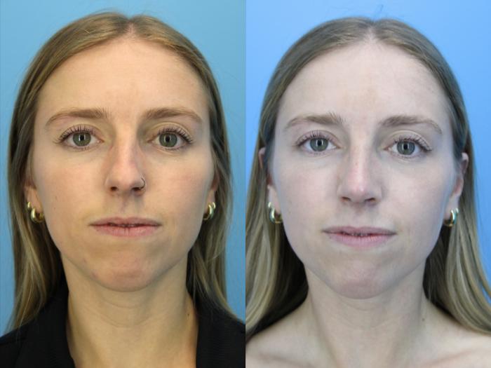 Before & After Rhinoplasty Case 634 Front View in West Des Moines & Ames, IA