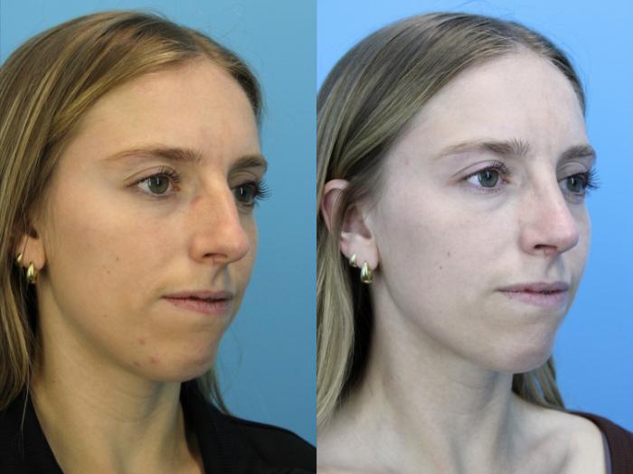 Before & After Rhinoplasty Case 634 Left Oblique View in West Des Moines & Ames, IA