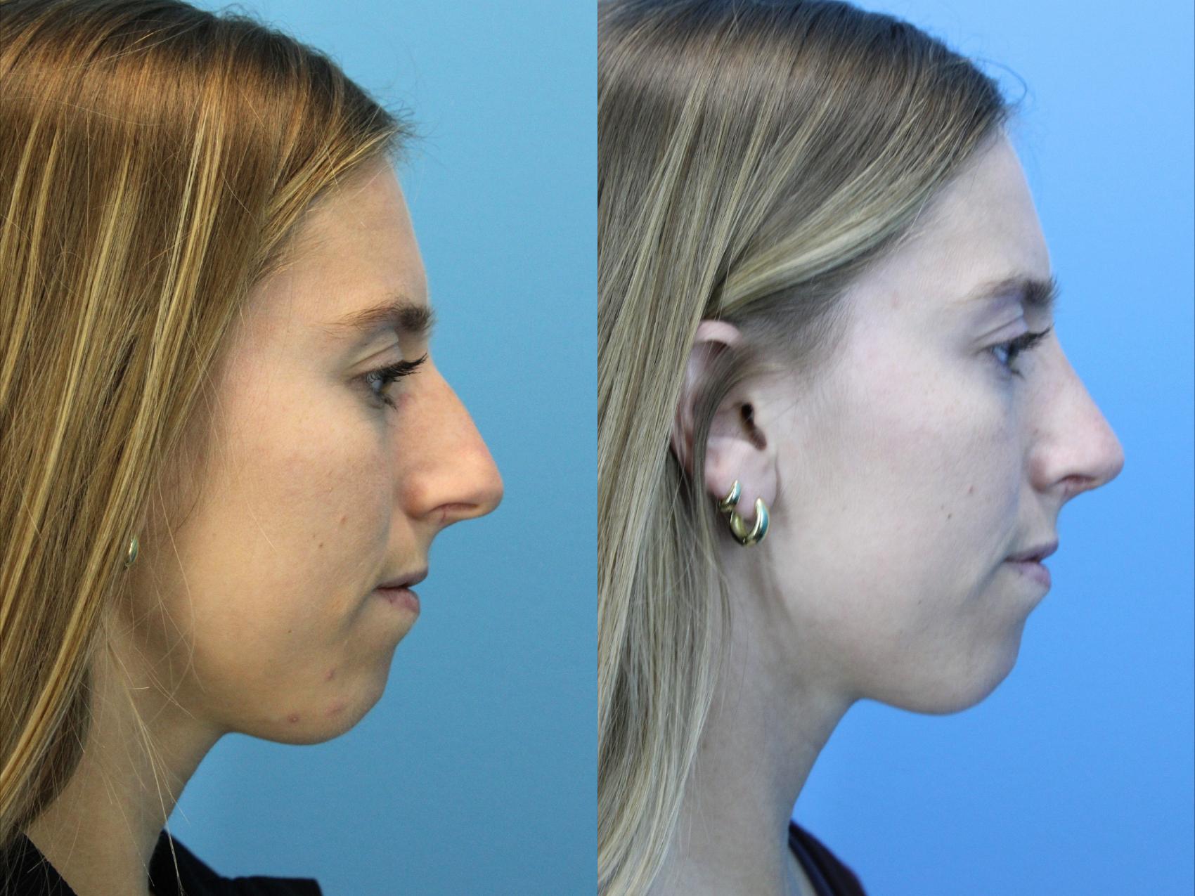 Before & After Rhinoplasty Case 634 Left Side View in West Des Moines & Ames, IA