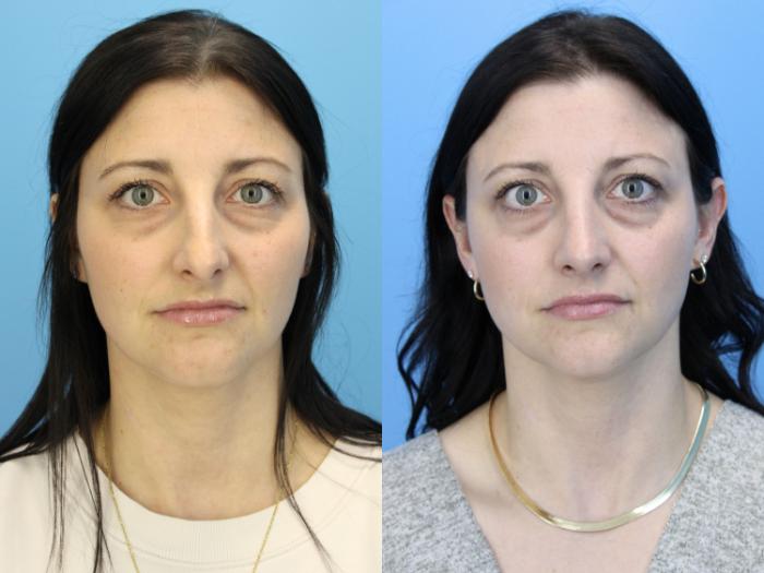 Before & After Rhinoplasty Case 635 Front View in West Des Moines & Ames, IA