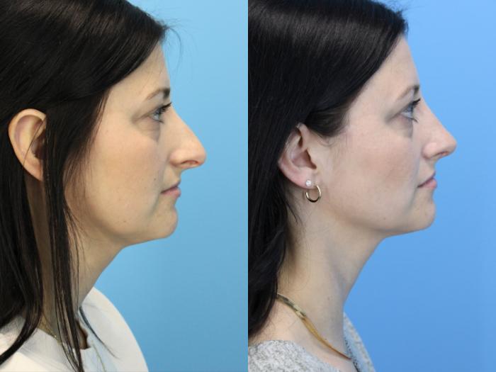 Before & After Rhinoplasty Case 635 Left Side View in West Des Moines & Ames, IA