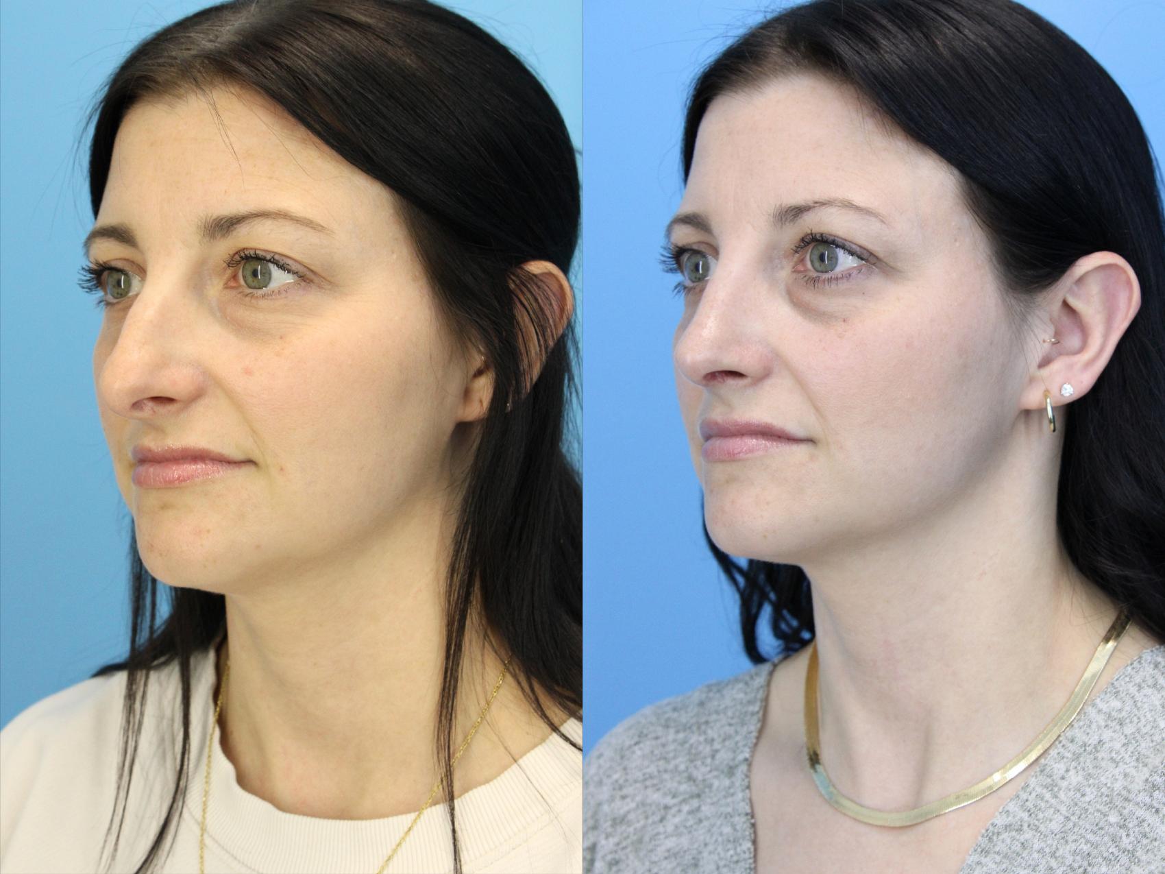 Before & After Rhinoplasty Case 635 Right Oblique View in West Des Moines & Ames, IA