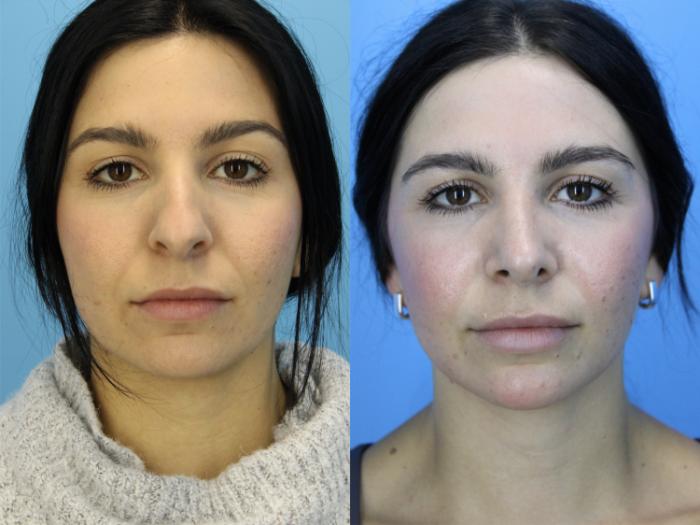 Before & After Rhinoplasty Case 650 Front View in West Des Moines & Ames, IA