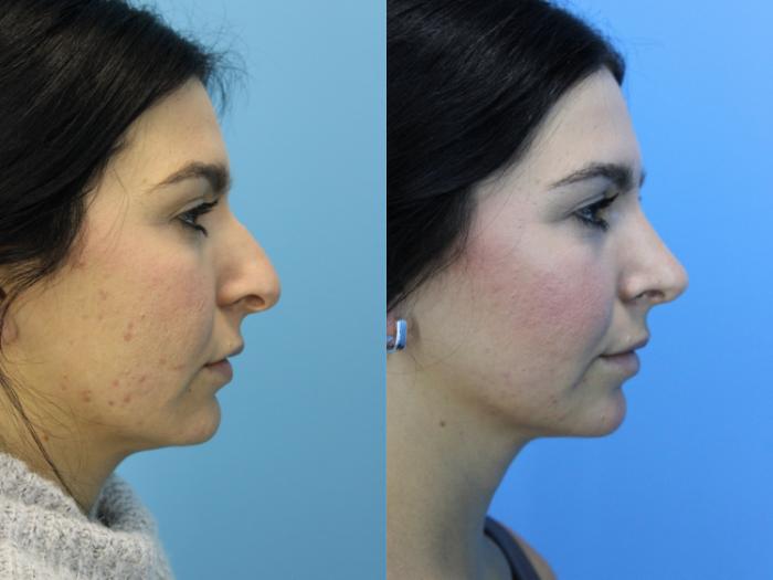 Before & After Rhinoplasty Case 650 Left Side View in West Des Moines & Ames, IA