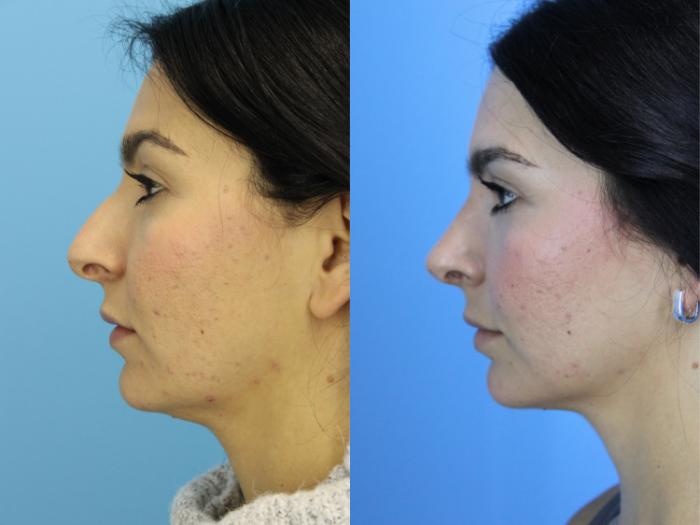 Before & After Rhinoplasty Case 650 Right Side View in West Des Moines & Ames, IA