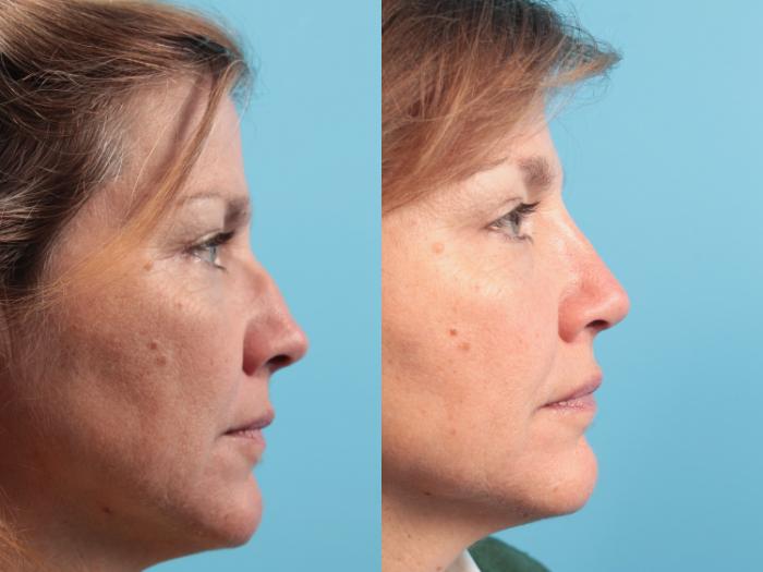 Before & After Rhinoplasty Case 75 Right Side View in West Des Moines & Ames, IA