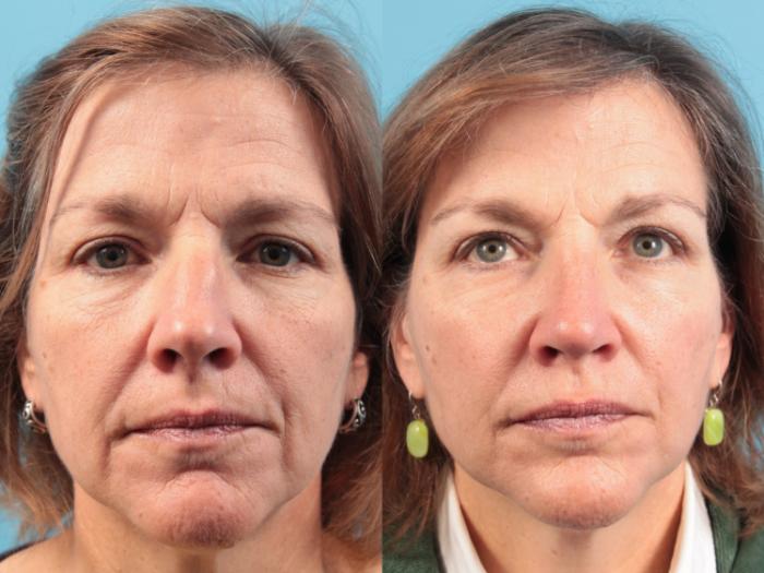 Before & After Rhinoplasty Case 75 View #2 View in West Des Moines & Ames, IA