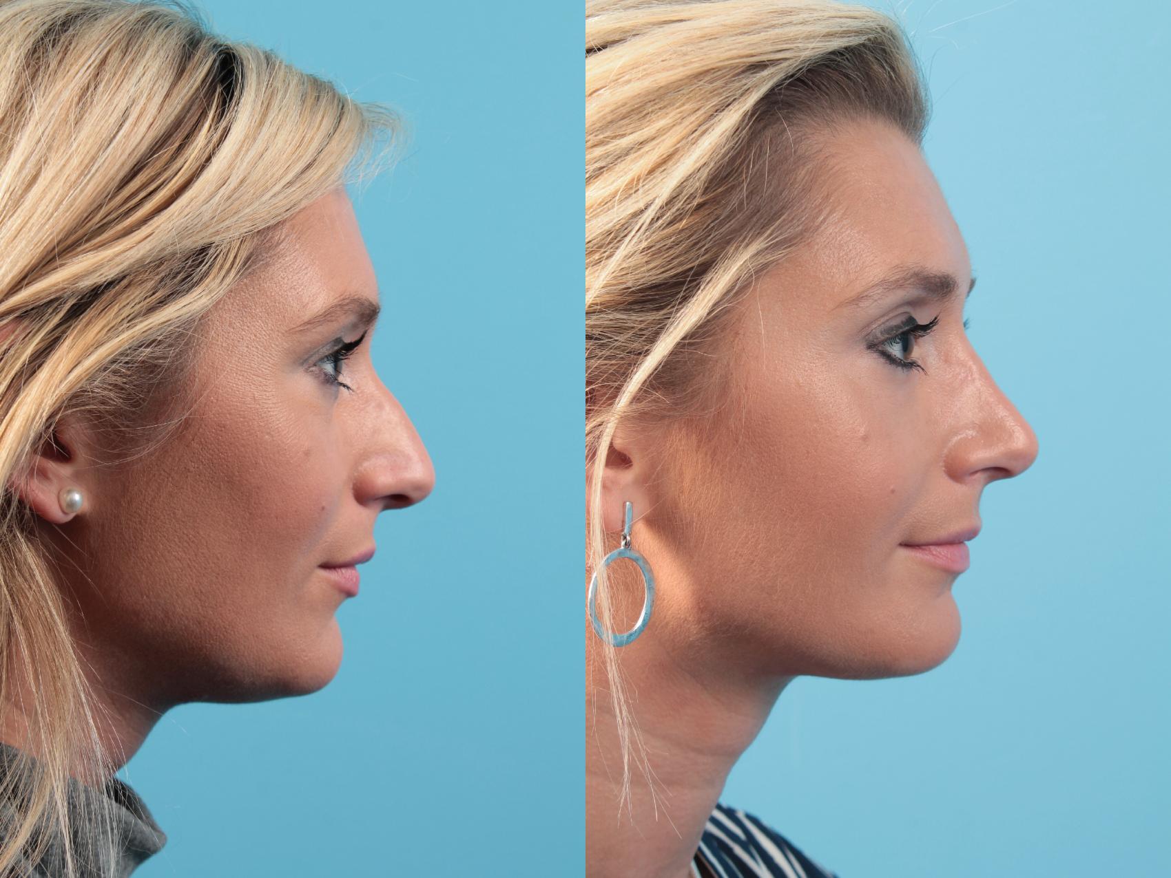 Before & After Rhinoplasty Case 77 View #1 View in West Des Moines & Ames, IA