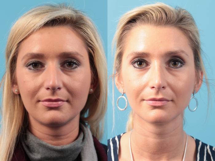 Before & After Rhinoplasty Case 77 View #2 View in West Des Moines & Ames, IA