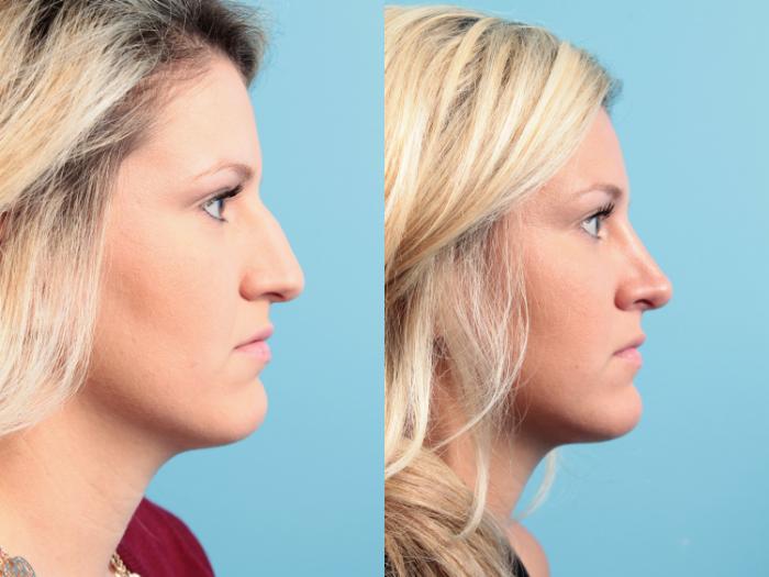 Before & After Rhinoplasty Case 90 View #1 View in West Des Moines & Ames, IA