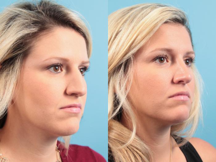 Before & After Rhinoplasty Case 90 View #2 View in West Des Moines & Ames, IA