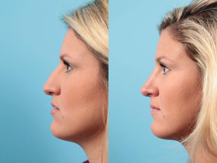 Before & After Rhinoplasty Case 90 View #3 View in West Des Moines & Ames, IA