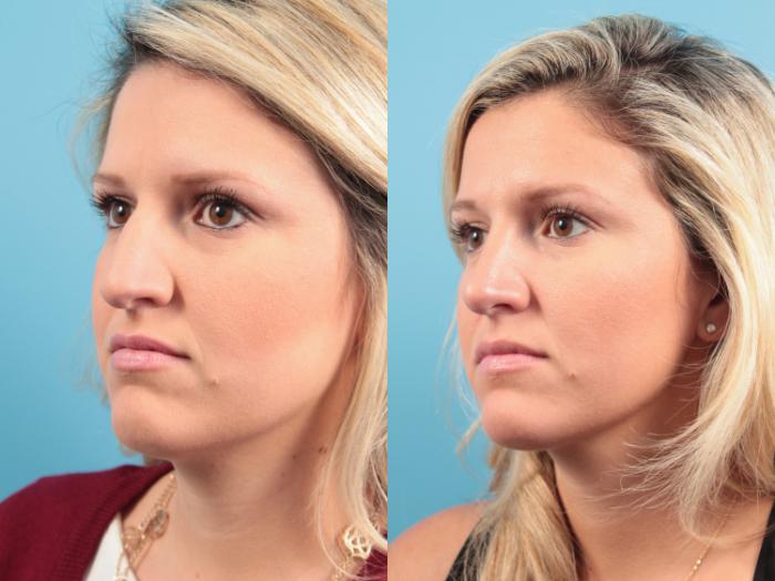 Before & After Rhinoplasty Case 90 View #4 View in West Des Moines & Ames, IA