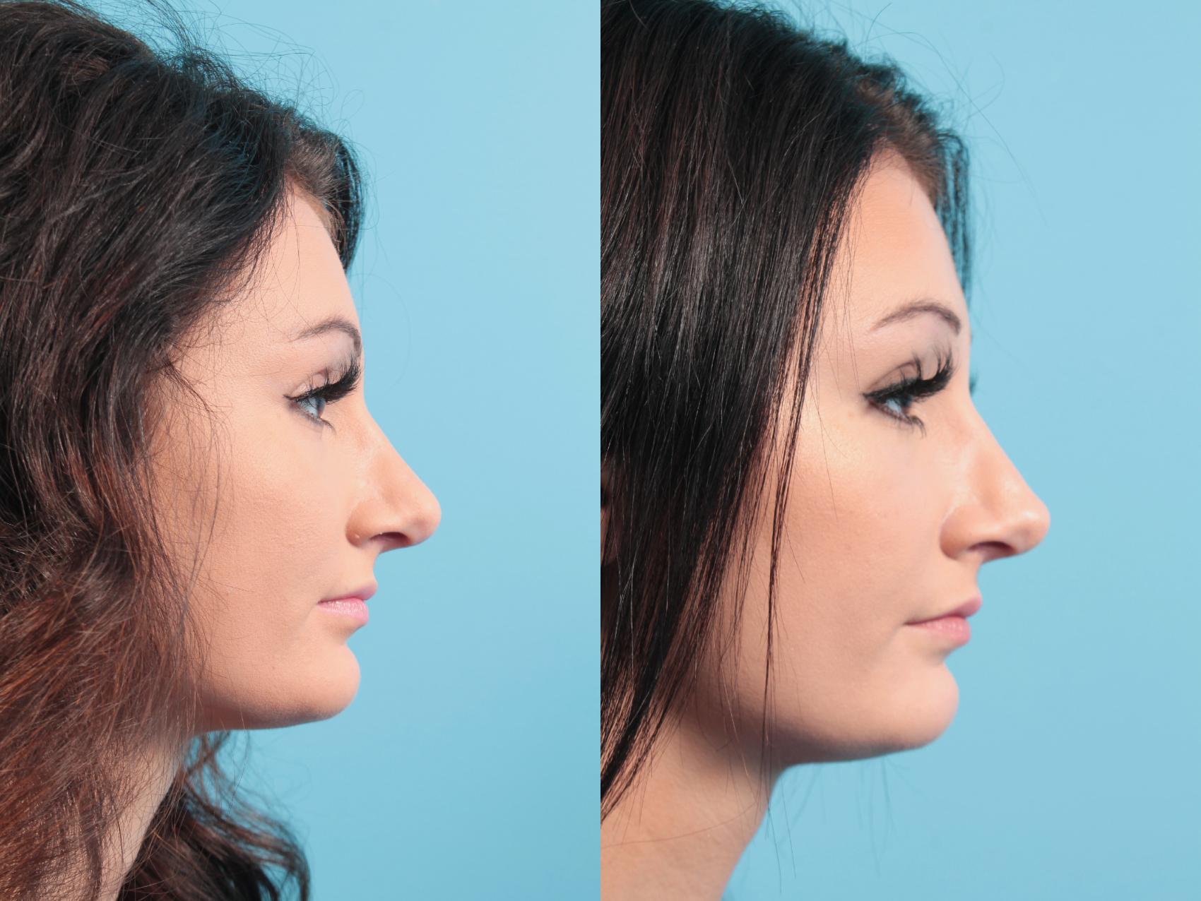 Before & After Rhinoplasty Case 93 View #1 View in West Des Moines & Ames, IA