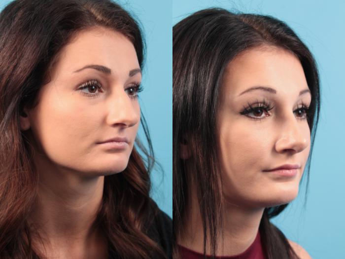 Before & After Rhinoplasty Case 93 View #2 View in West Des Moines & Ames, IA