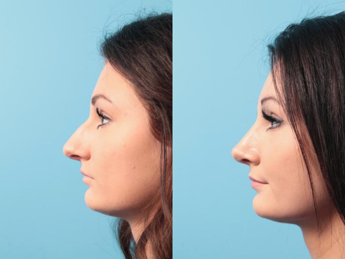 Before & After Rhinoplasty Case 93 View #3 View in West Des Moines & Ames, IA
