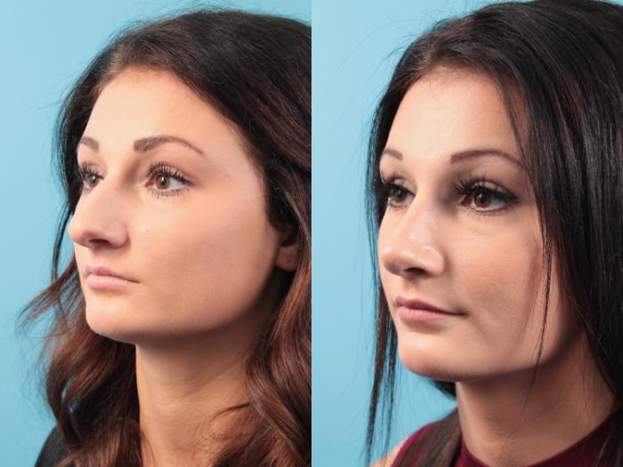 Before & After Rhinoplasty Case 93 View #4 View in West Des Moines & Ames, IA