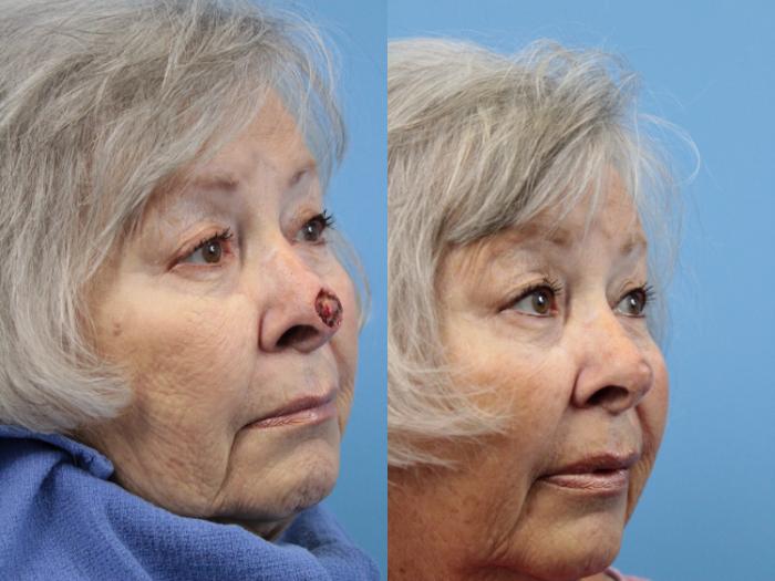 Before & After Skin Cancer Repair Case 119 View #2 View in West Des Moines & Ames, IA