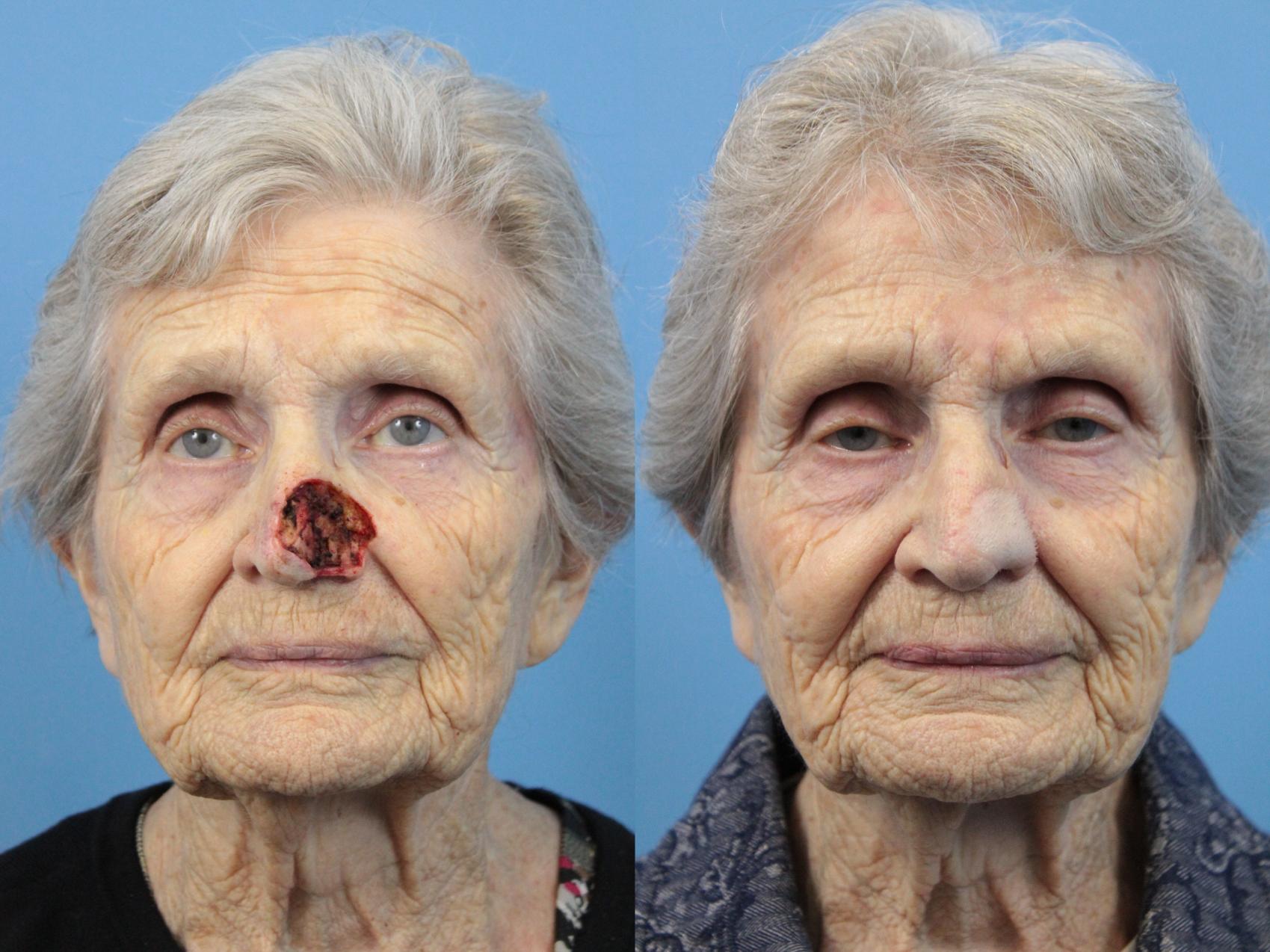Before & After Skin Cancer Repair Case 136 Front View in West Des Moines & Ames, IA