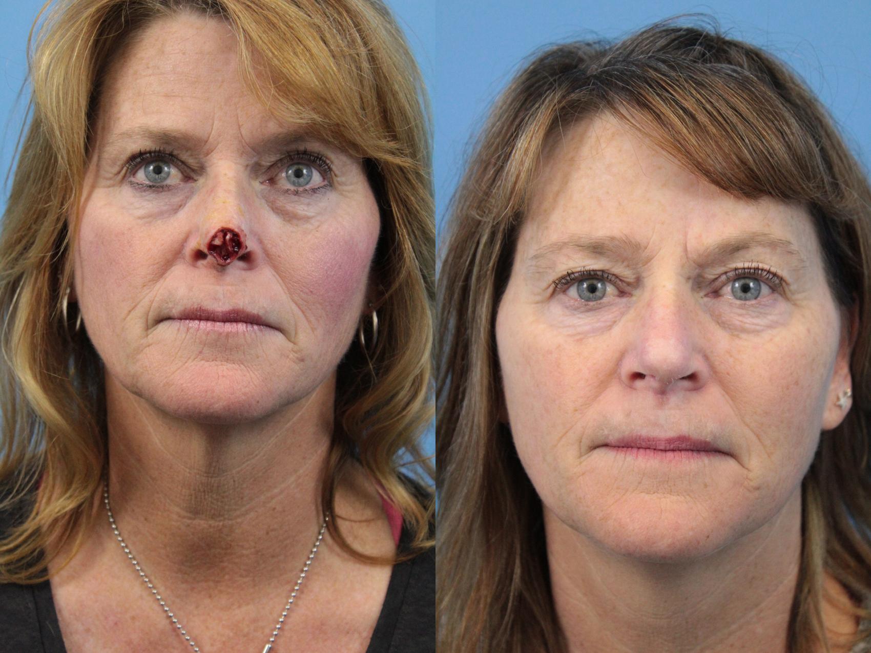 Before & After Skin Cancer Repair Case 140 View #1 View in West Des Moines & Ames, IA