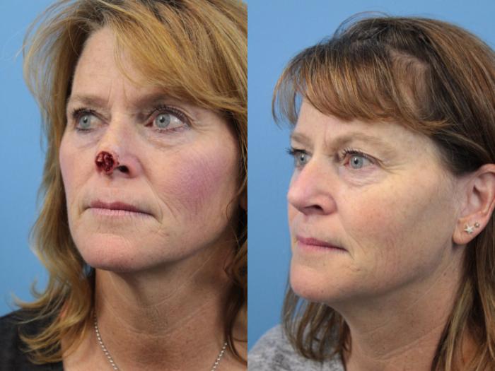 Before & After Skin Cancer Repair Case 140 View #2 View in West Des Moines & Ames, IA