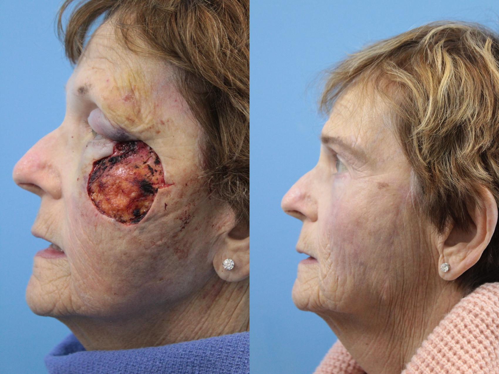 Before & After Skin Cancer Repair Case 154 View #1 View in West Des Moines & Ames, IA