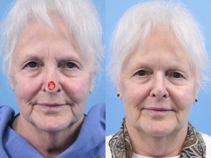 Before & After Skin Cancer Repair Case 158 View #1 View in West Des Moines & Ames, IA