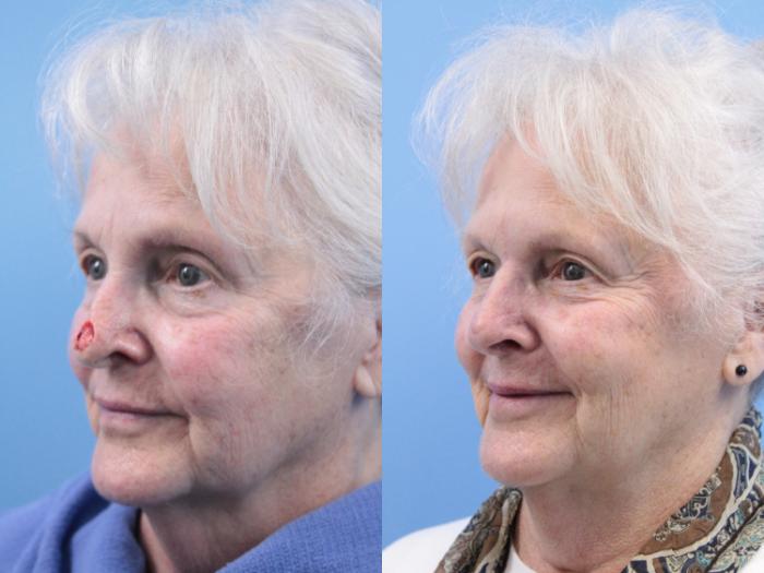 Before & After Skin Cancer Repair Case 158 View #2 View in West Des Moines & Ames, IA
