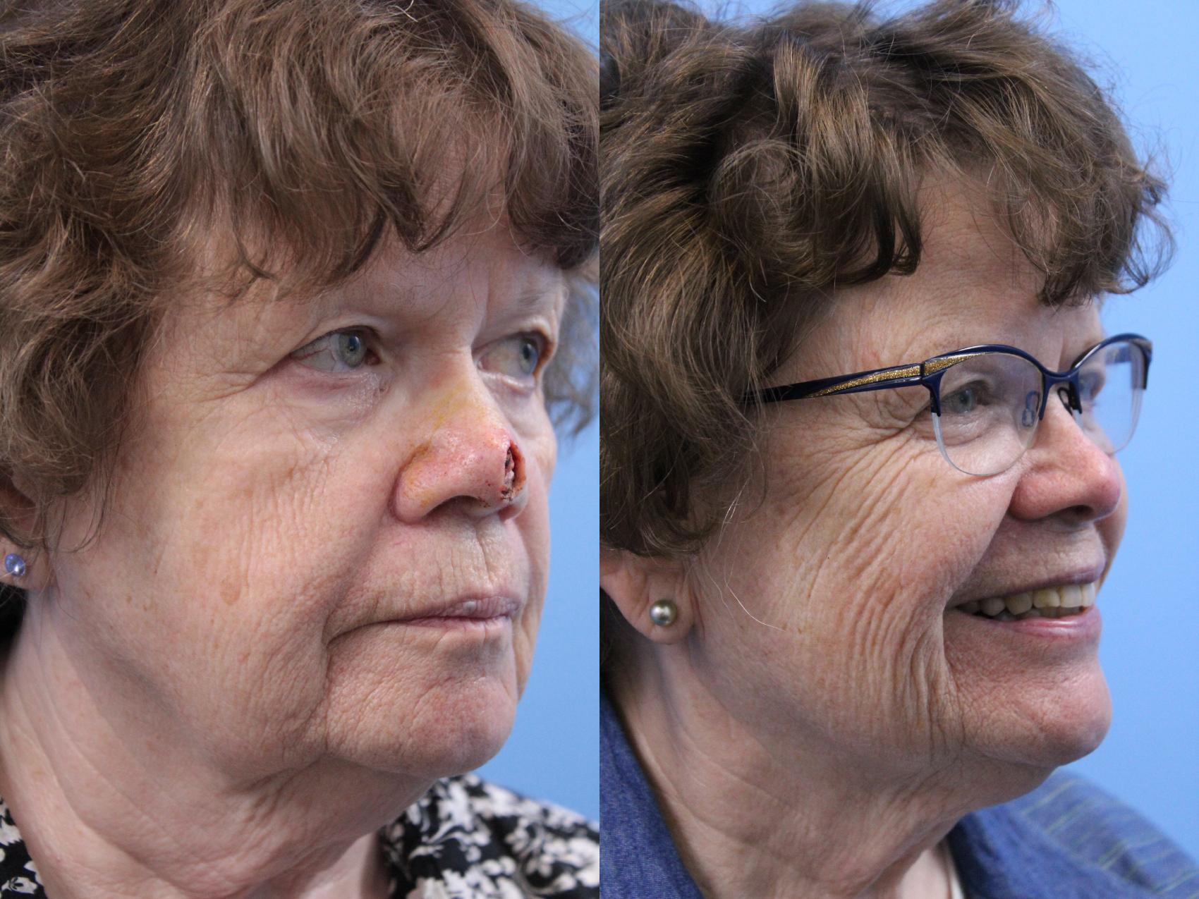 skin-cancer-repair-before-and-after-pictures-case-183-west-des-moines