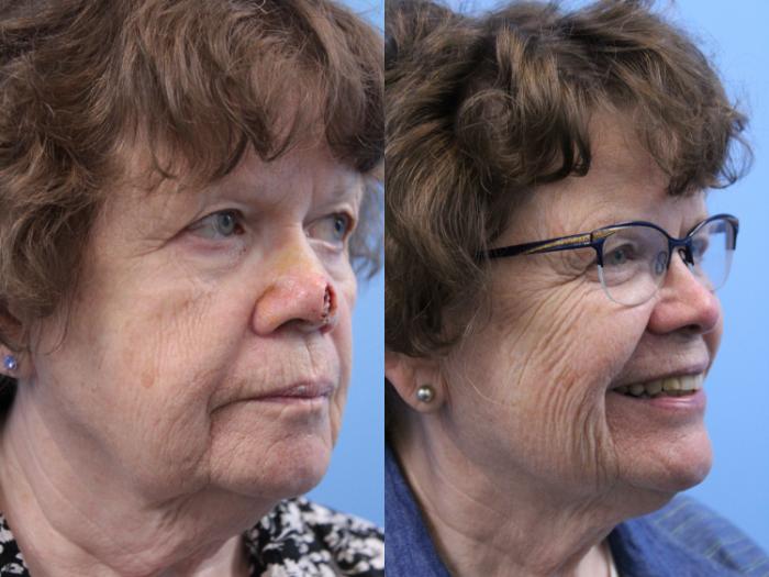 Before & After Skin Cancer Repair Case 183 View #2 View in West Des Moines & Ames, IA