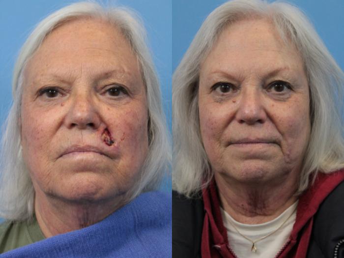 Before & After Skin Cancer Repair Case 188 Front View in West Des Moines & Ames, IA