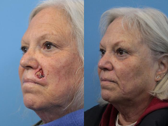 Before & After Skin Cancer Repair Case 188 Left Oblique View in West Des Moines & Ames, IA