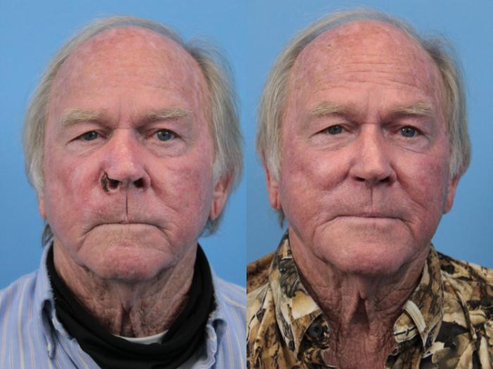 Before & After Skin Cancer Repair Case 190 Front View in West Des Moines & Ames, IA