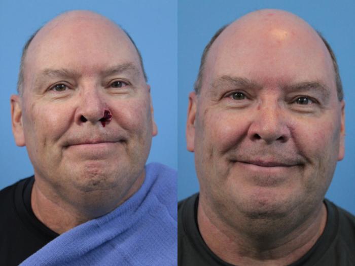 Before & After Skin Cancer Repair Case 211 Front View in West Des Moines & Ames, IA
