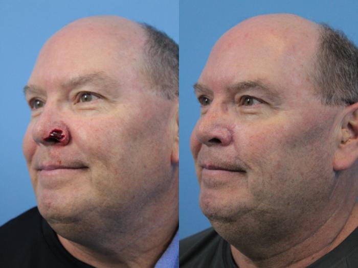 Before & After Skin Cancer Repair Case 211 Left Oblique View in West Des Moines & Ames, IA