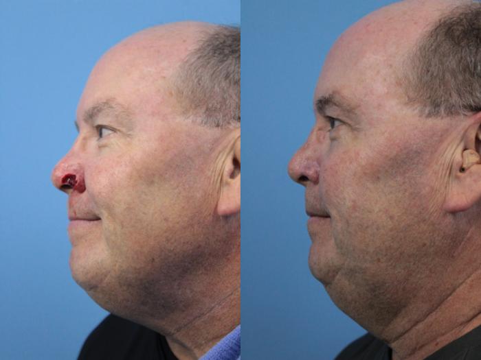 Before & After Skin Cancer Repair Case 211 Left Side View in West Des Moines & Ames, IA
