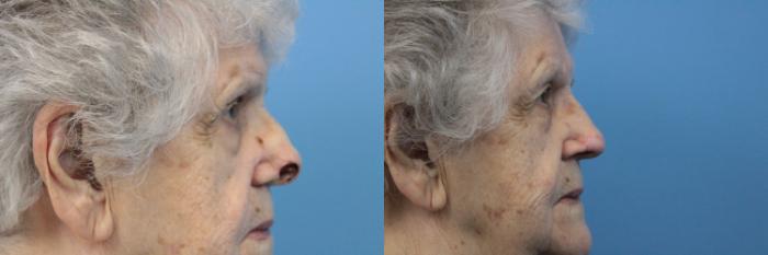 Before & After Skin Cancer Repair Case 212 Right Side View in West Des Moines & Ames, IA