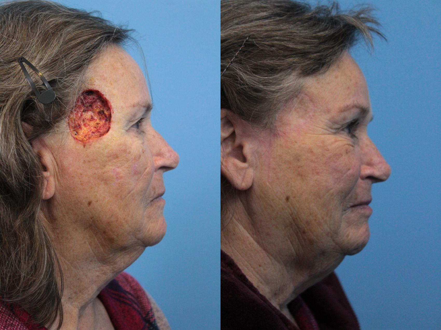 Before & After Skin Cancer Repair Case 213 Right Side View in West Des Moines & Ames, IA