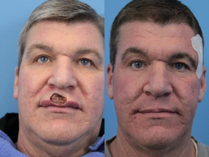 Before & After Skin Cancer Repair Case 228 Front View in West Des Moines & Ames, IA