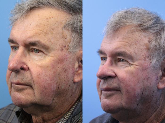 Before & After Skin Cancer Repair Case 248 Left Oblique View in West Des Moines & Ames, IA