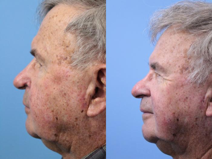 Before & After Skin Cancer Repair Case 248 Left Side View in West Des Moines & Ames, IA