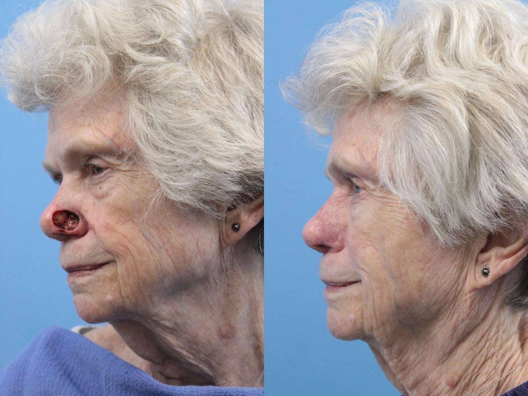 Before & After Skin Cancer Repair Case 253 Front View in West Des Moines & Ames, IA
