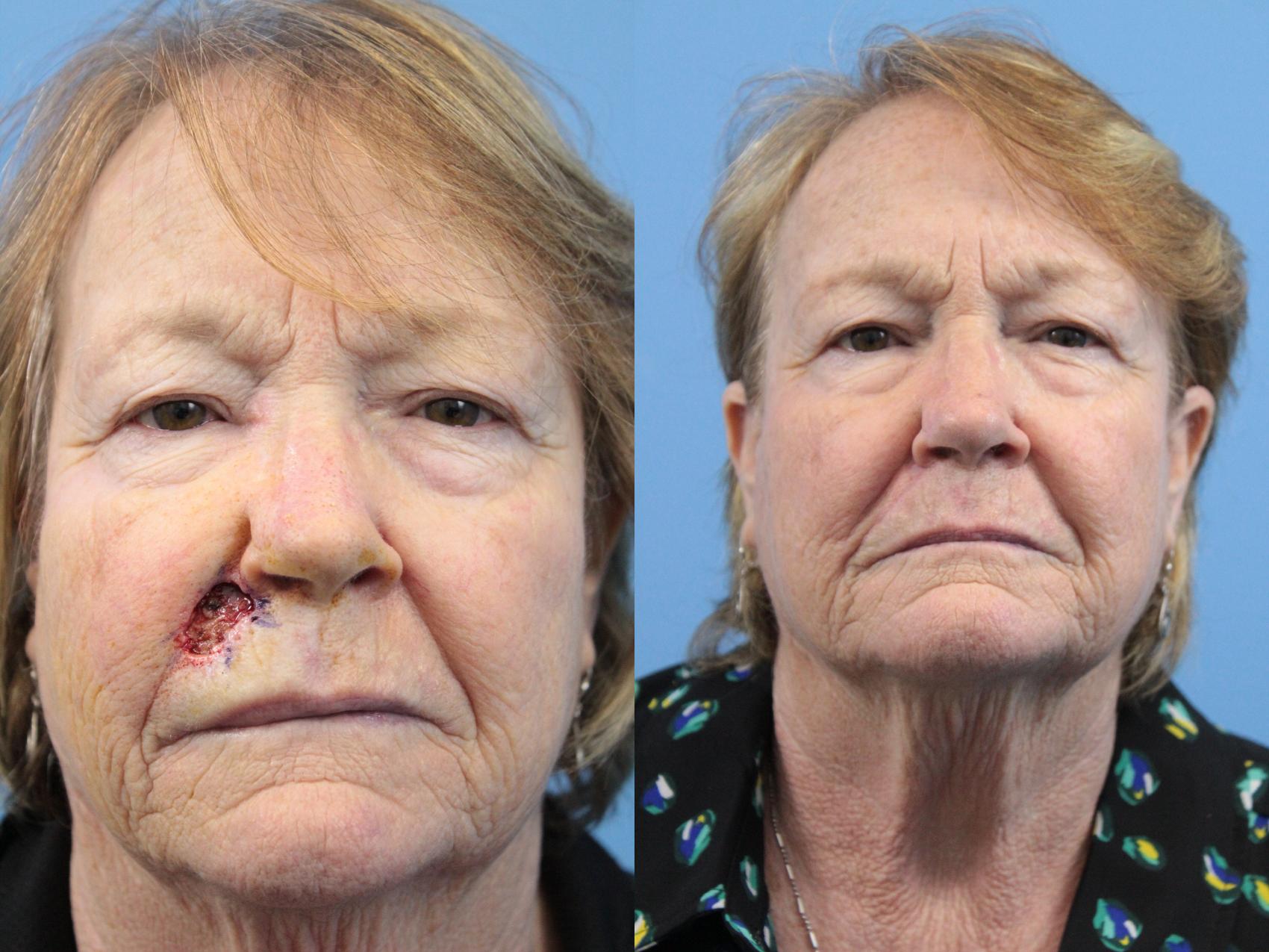 Before & After Skin Cancer Repair Case 254 Front View in West Des Moines & Ames, IA