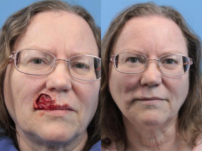 Before & After Skin Cancer Repair Case 256 Front View in West Des Moines & Ames, IA